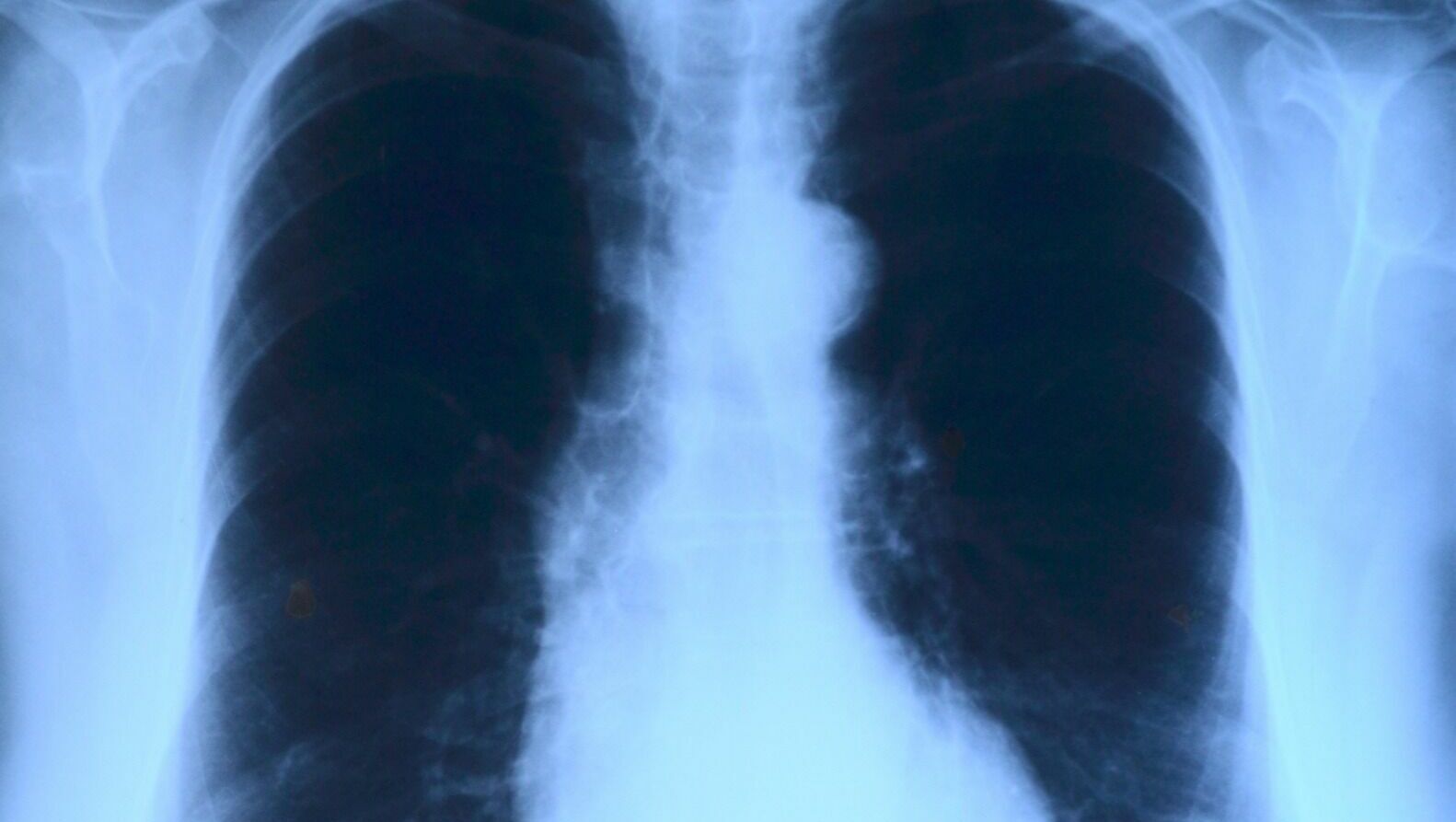 Ростовские медики рассказали о неуязвимости туберкулёза